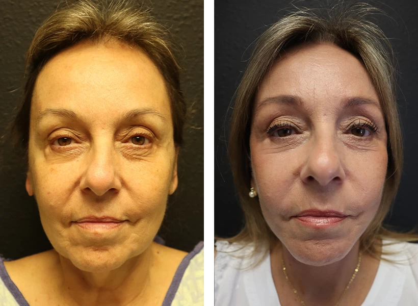 Facelift-Case-10-front