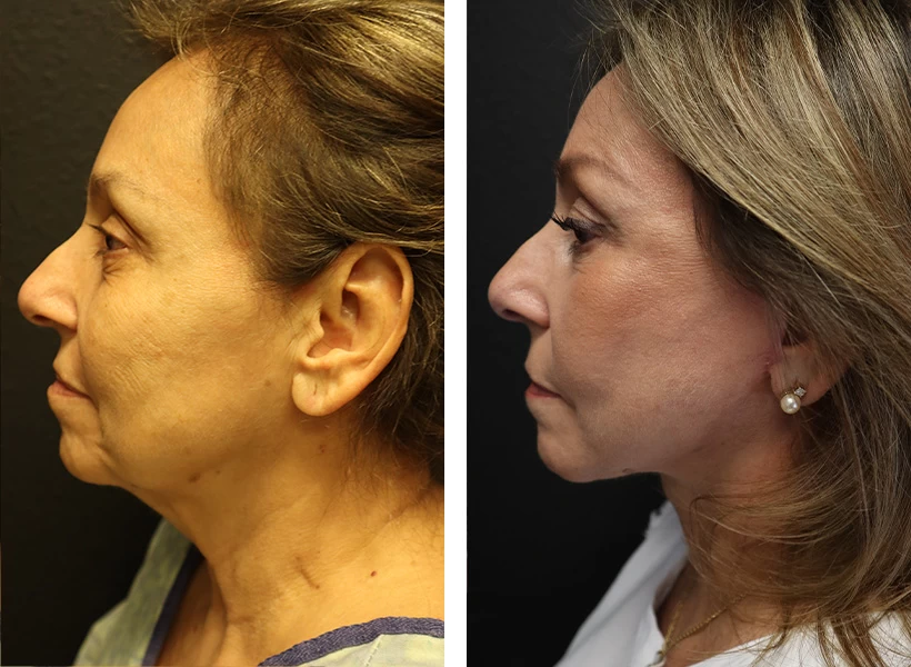 Facelift-Case-10-left