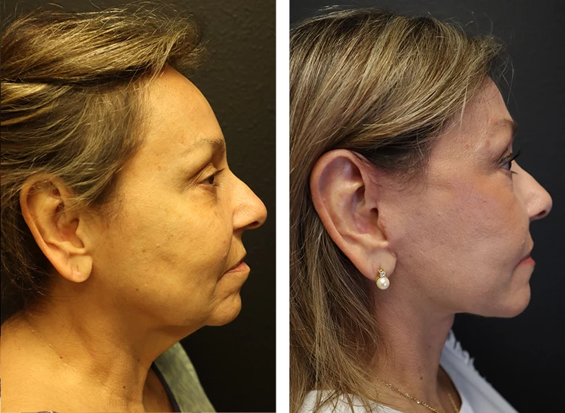 Facelift-Case-10-right-profile