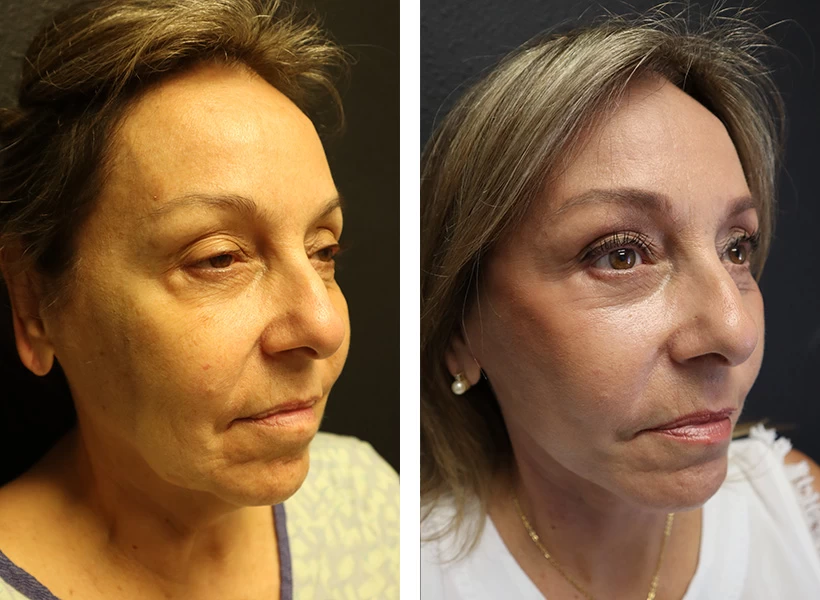 Facelift-Case-10-right