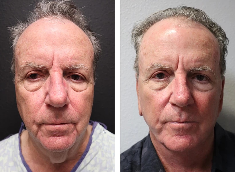 Facelift-Case-4-front