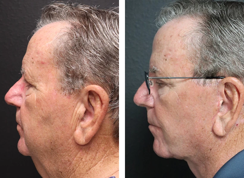 Facelift-Case-4-left-profile