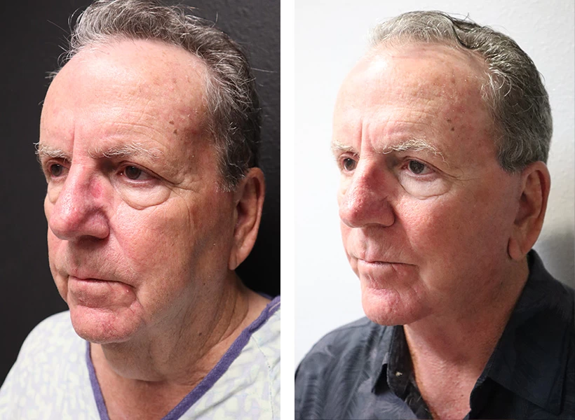 Facelift-Case-4-left