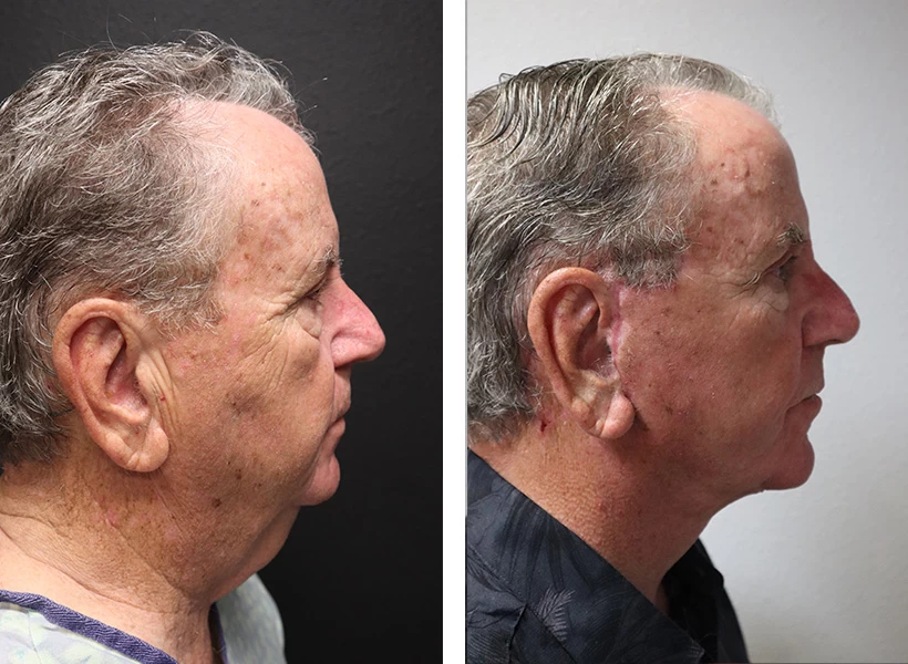 Facelift-Case-4-right-profile