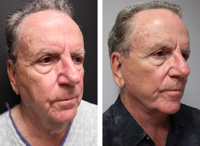 Facelift-Case-4-right