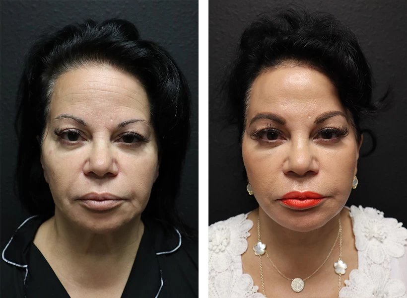 Facelift-case-1-front-1