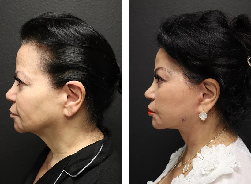 Facelift-case-1-left-profile