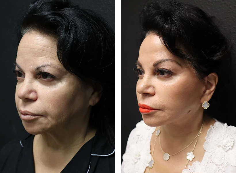 Facelift-case-1-left