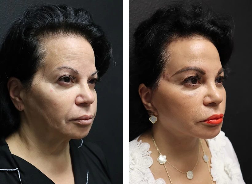 Facelift-case-1-right