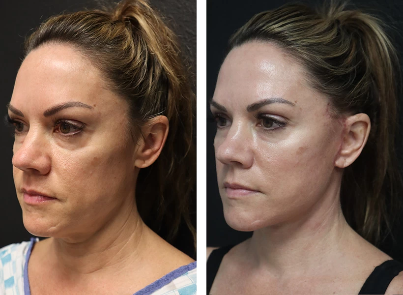 Facelift-case-3-left