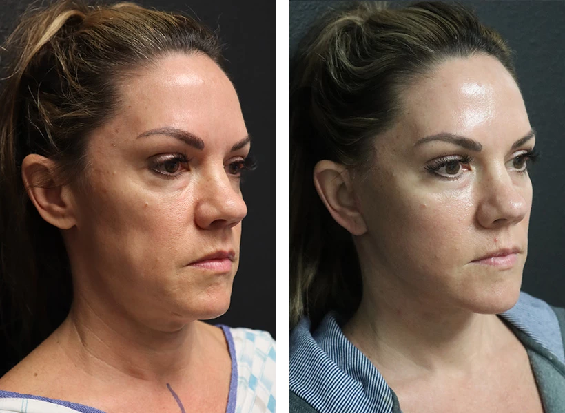 Facelift-case-3-right